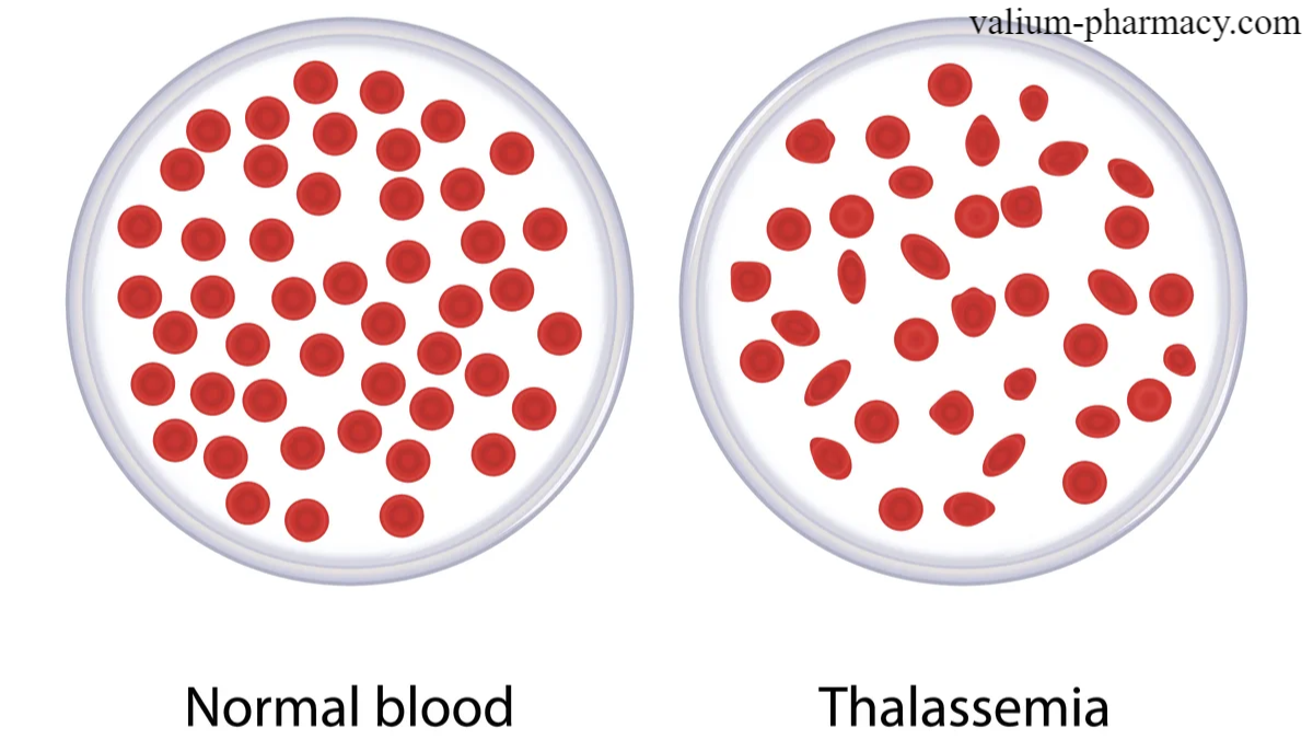 Apa itu Thalassemia?